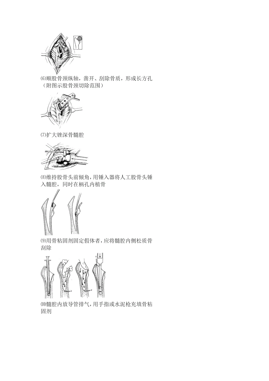 人工股骨头置换术_第2页