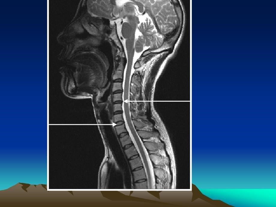 脊髓和椎管内疾病_第5页