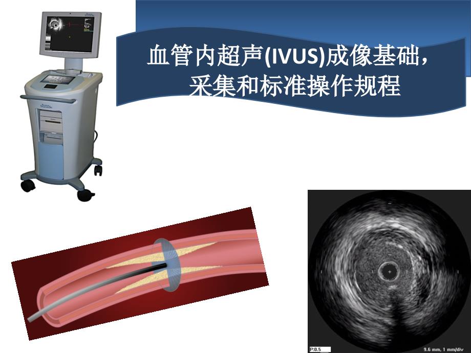 血管内超声IVUS简介_第1页