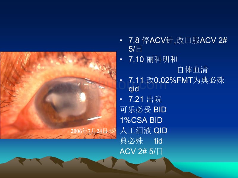 几种特殊类型单疱病毒性角膜炎的诊疗_第4页