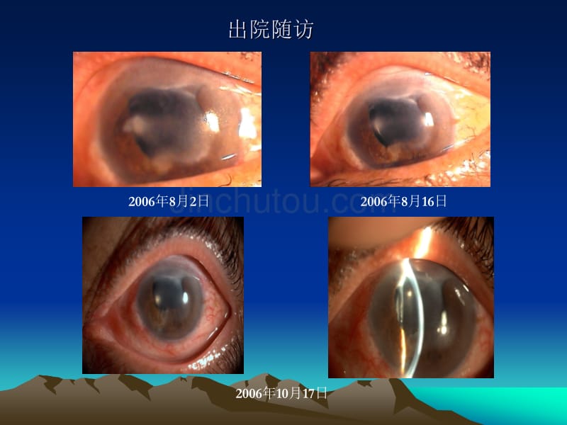 几种特殊类型单疱病毒性角膜炎的诊疗_第5页