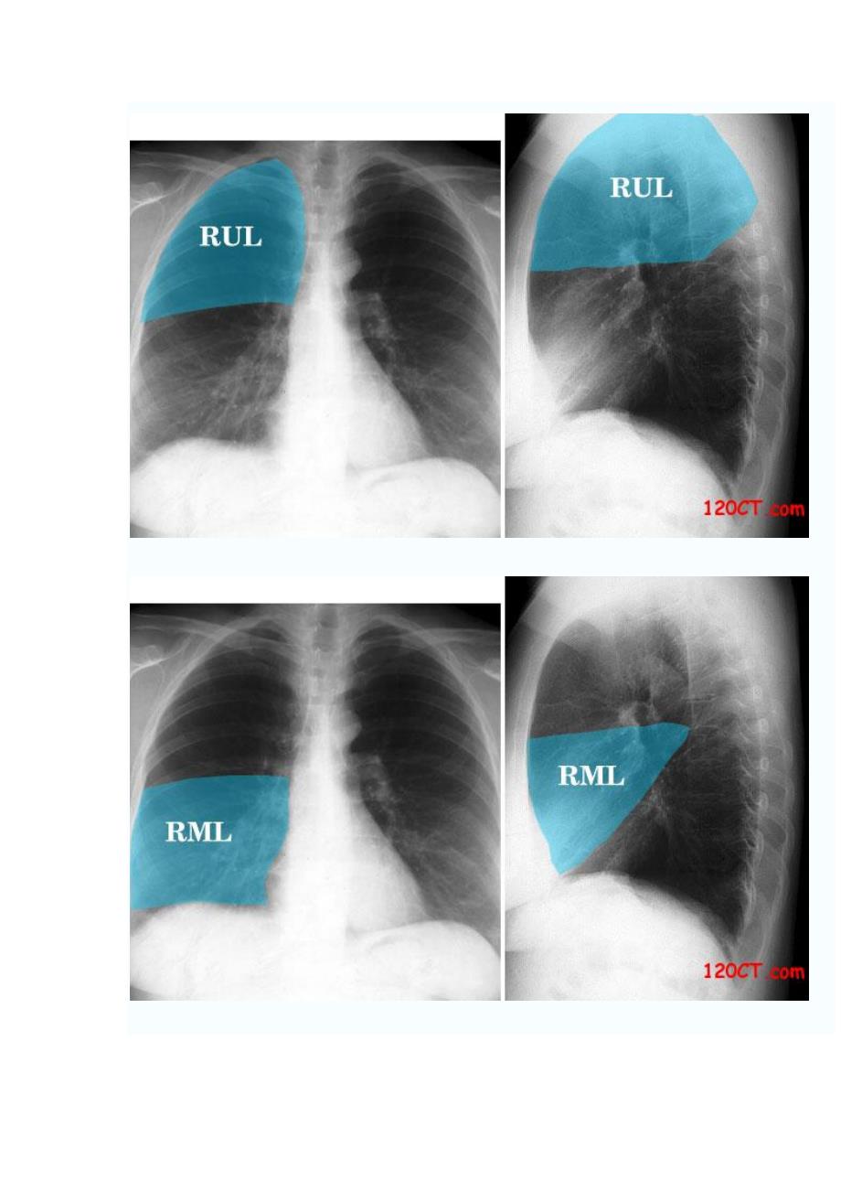 右肺叶、肺段及胸膜的x线胸片定位_第2页