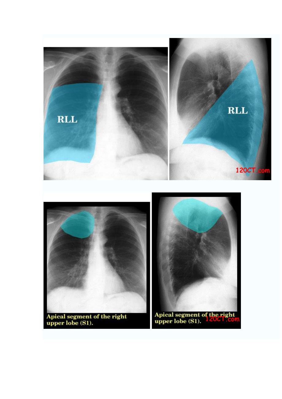 右肺叶、肺段及胸膜的x线胸片定位_第3页