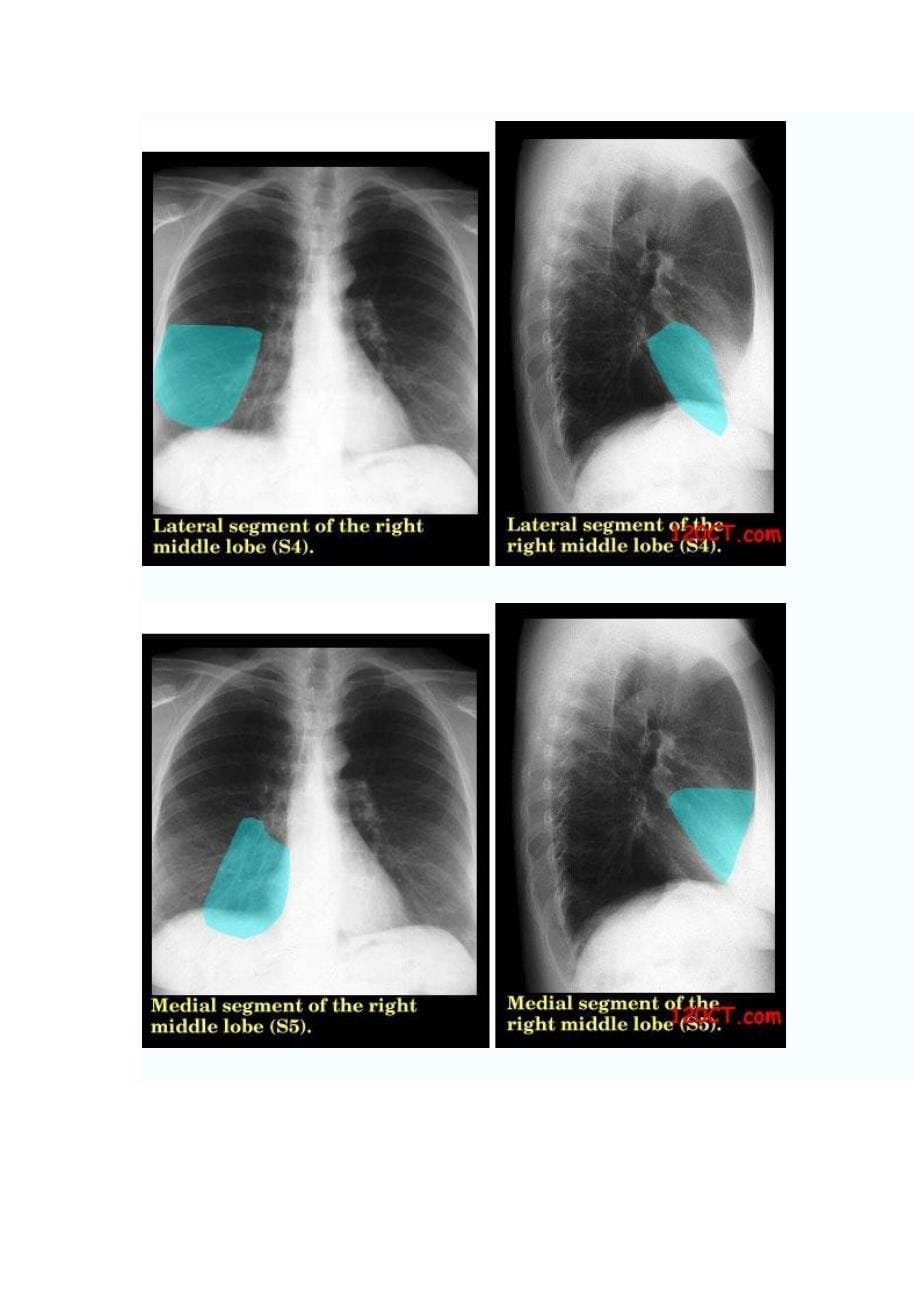 右肺叶、肺段及胸膜的x线胸片定位_第5页
