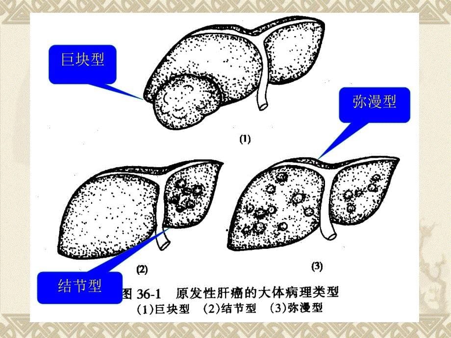 内科护理学原发性肝癌_第5页