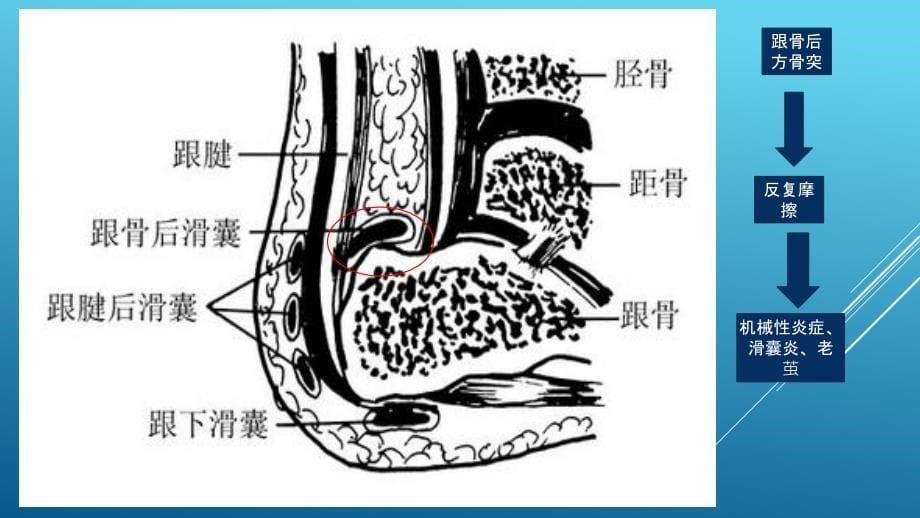 关节镜下跟骨成形术(ecp)_第5页