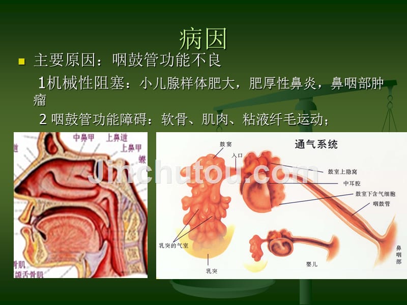 分泌性中耳炎的护理_第4页