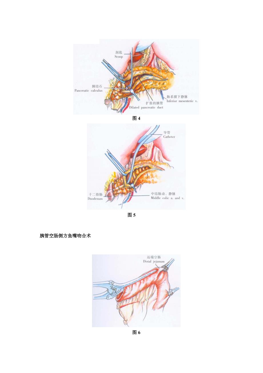 胰管空肠吻合术_第4页