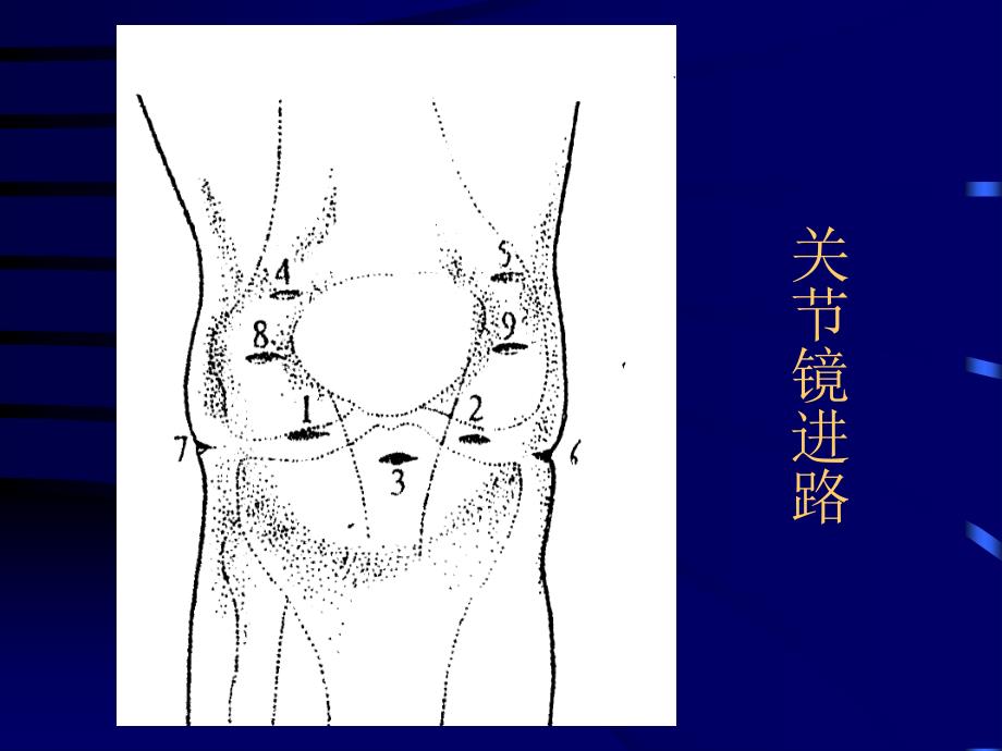 膝关节镜检查和治疗_第3页