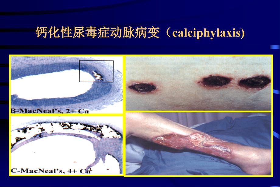 慢性肾脏病时的钙磷代谢异常及骨病_第4页