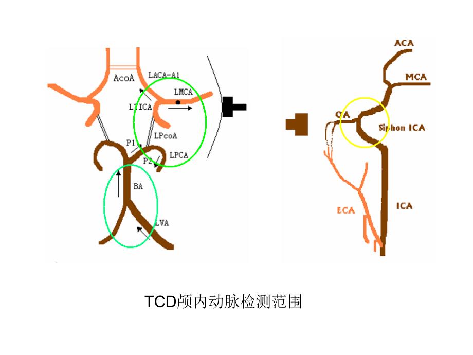 卒中的tcd进展_第5页