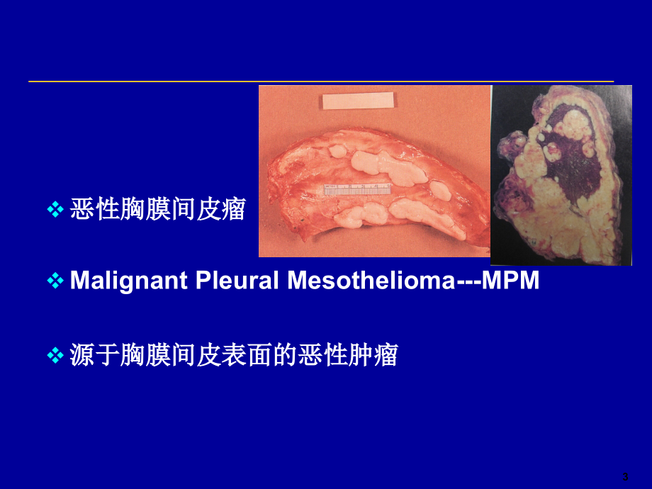 恶性胸膜间皮瘤2_第3页