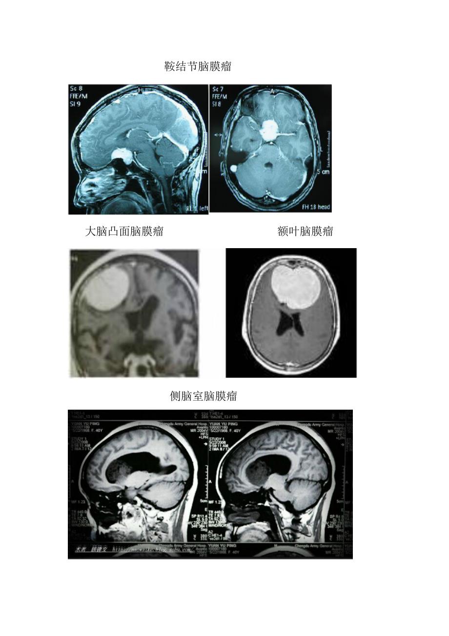 脑膜瘤手术的护理配合_第2页