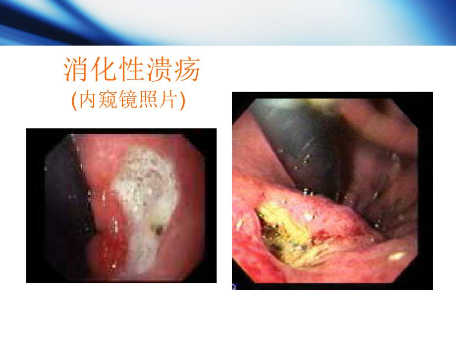 消化系统药物,h2受体阻断药 (护理药物学专科 习题)_第5页