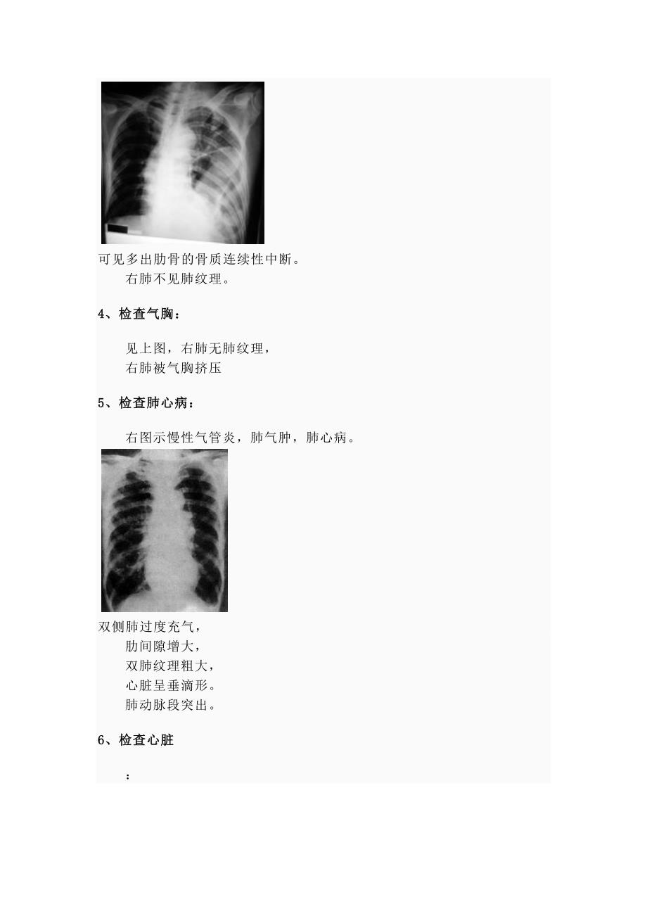 肋骨骨折x线图_第2页