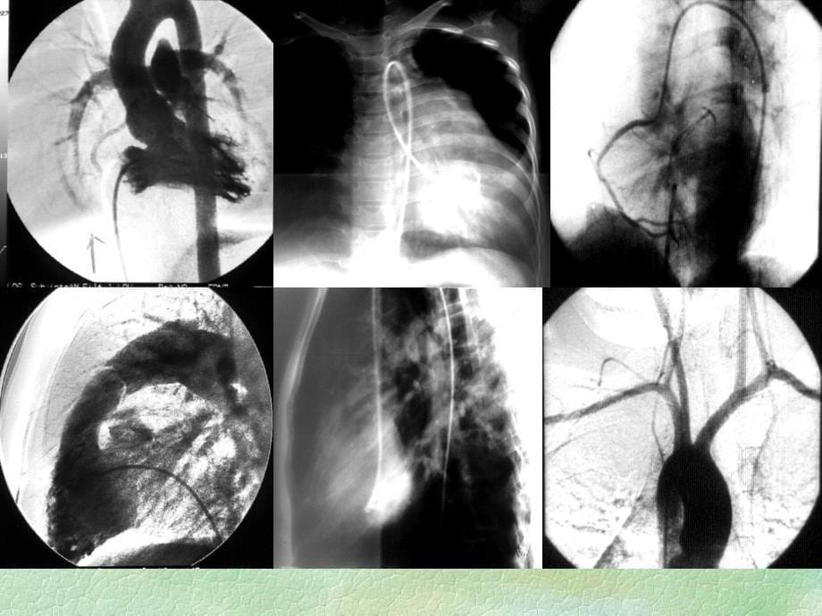 心脏X线诊断影像学_第5页