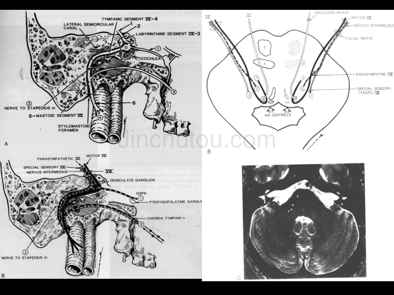 面神经的影像学诊断_第3页