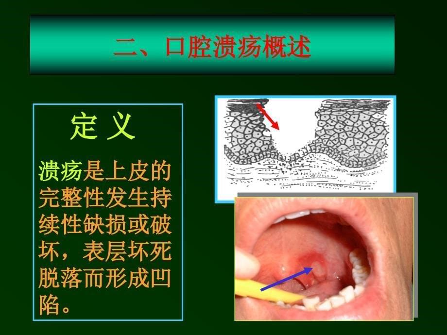 口腔溃疡诊断及鉴别_第5页