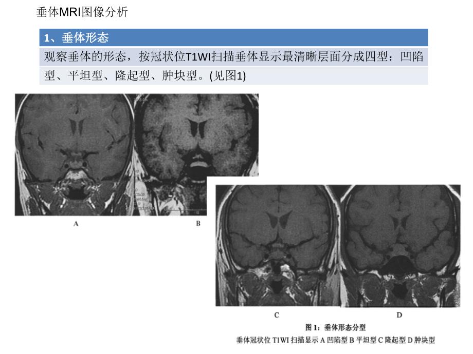 垂体增生与垂体瘤_第4页