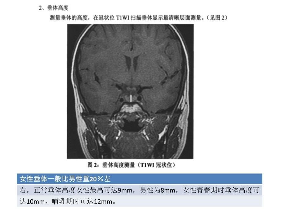 垂体增生与垂体瘤_第5页