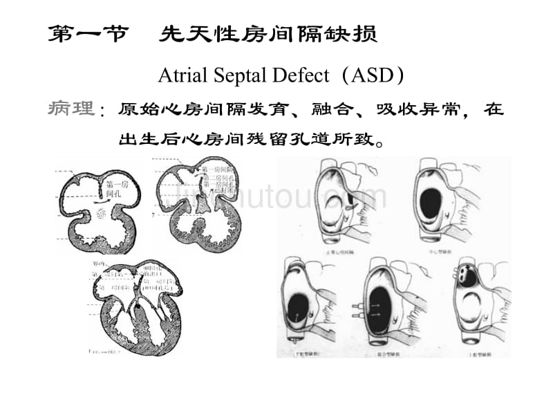 先天性心血管病_第3页