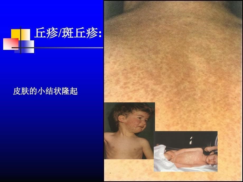 出疹性疾病水痘流行性腮腺炎猩红热_第5页