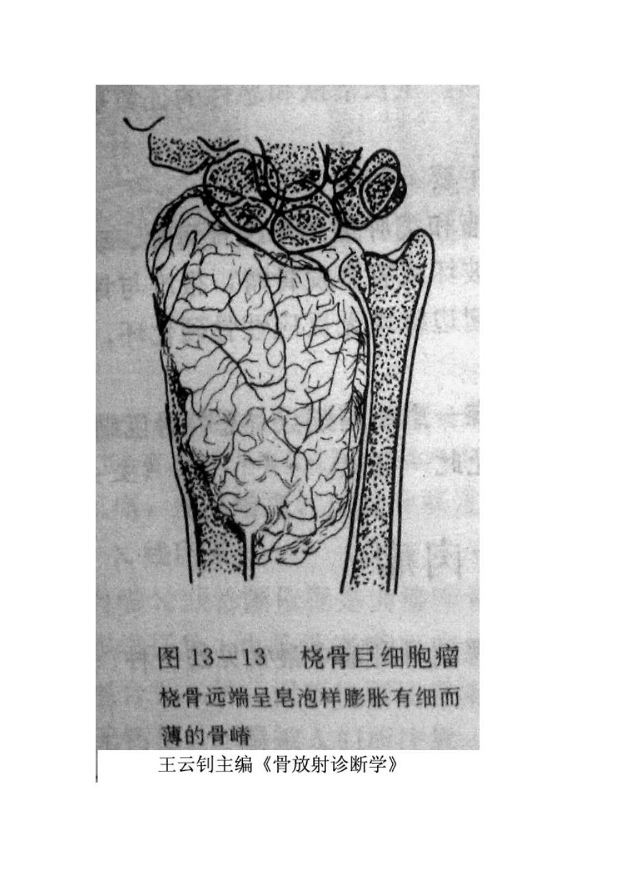 骨肿瘤-骨巨细胞瘤_第4页