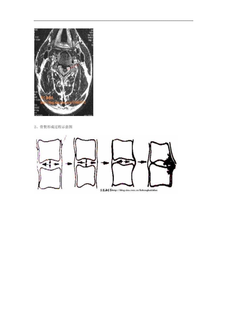 骨科系列讲座   颈椎病的诊治_第5页