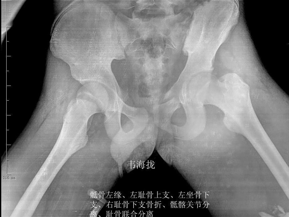 骨盆及下肢多发性骨折护理查房_第5页