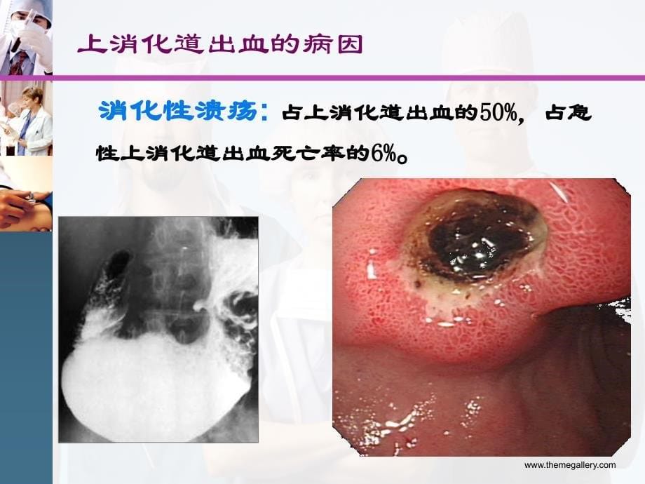 临床医学概要呕血与便血_第5页