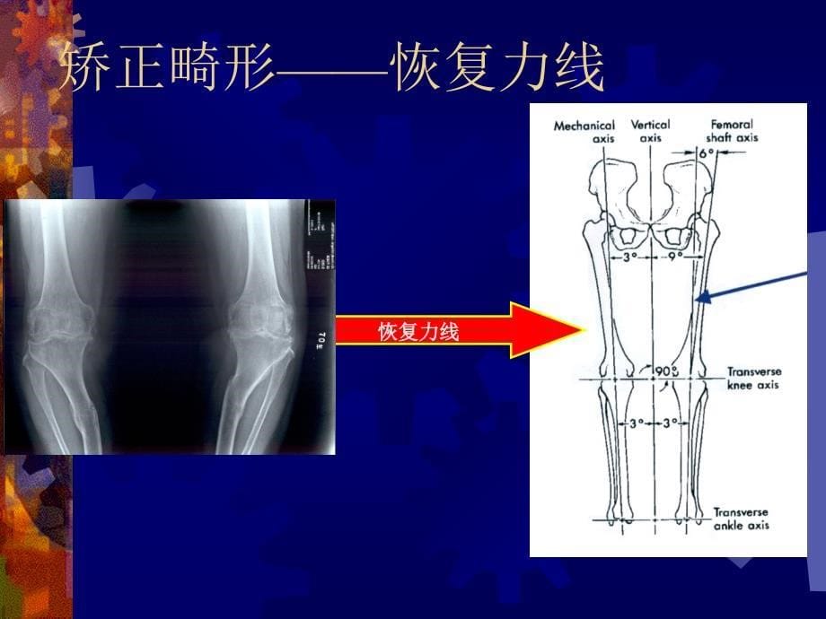 全膝关节置换术中的截骨与软组织平衡_第5页