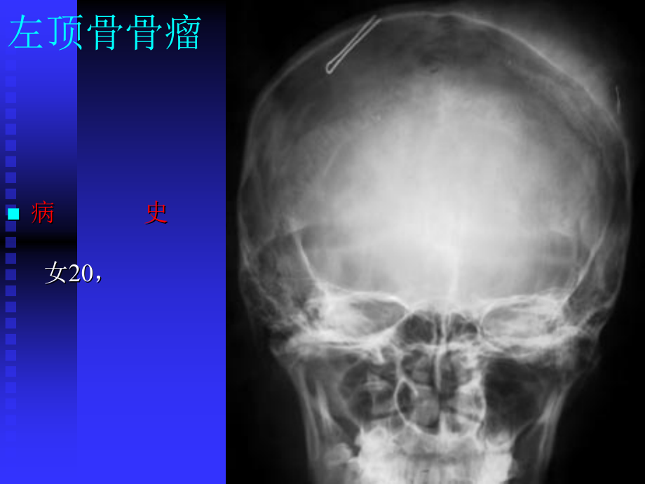 骨肿瘤X线病历图谱_第3页