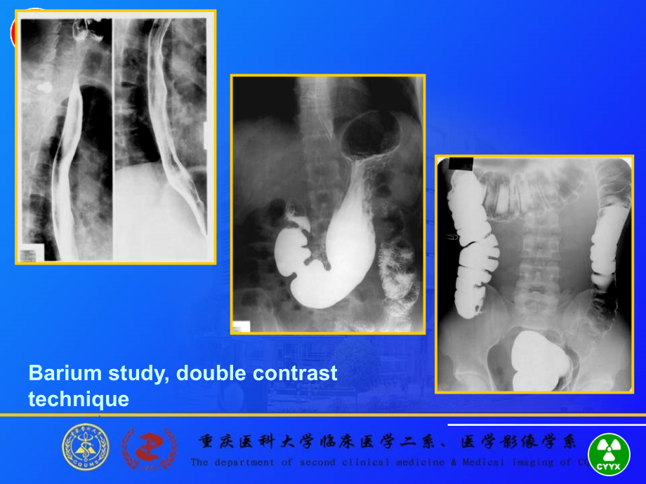 食管与胃肠道的影像诊断重医医学影像学_第4页