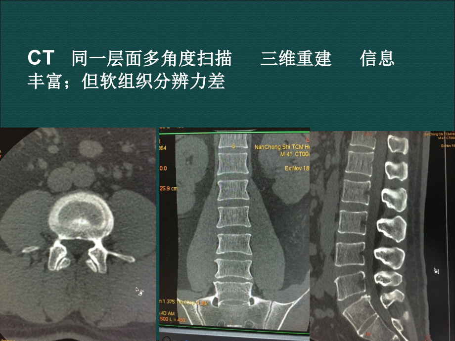 脊椎退行性变与椎管狭窄的影像诊断_第4页