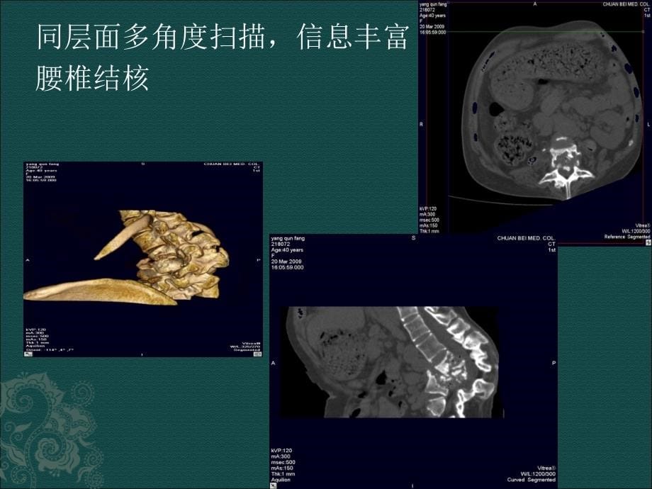 脊椎退行性变与椎管狭窄的影像诊断_第5页