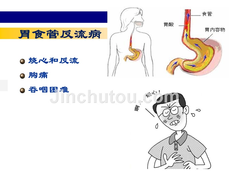 胃炎精华版_第3页