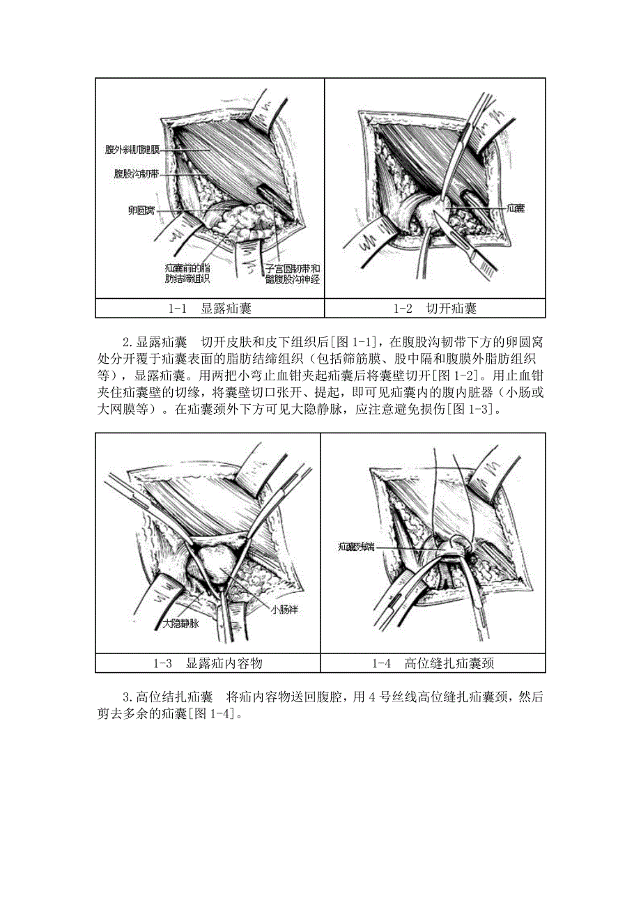 股疝修复术图谱_第2页