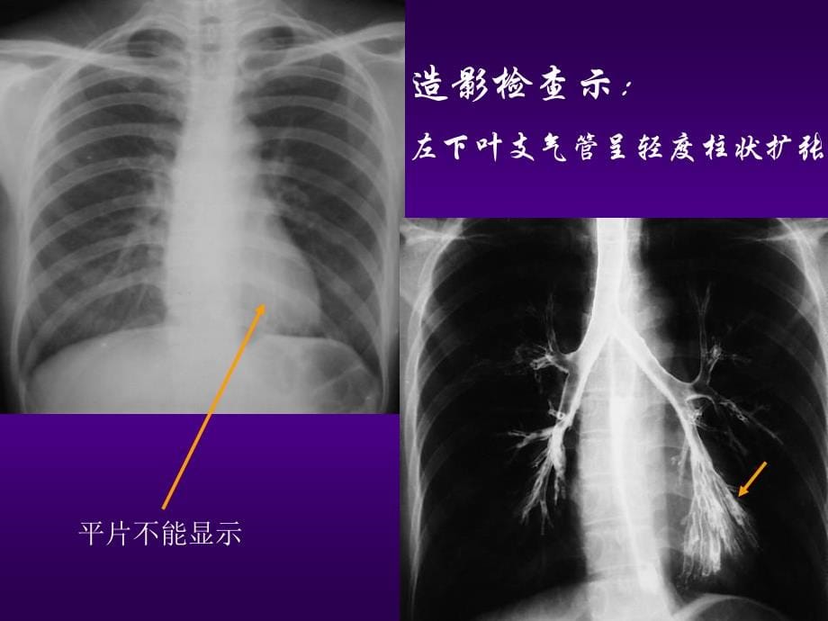 肺与纵膈影像诊断_第5页