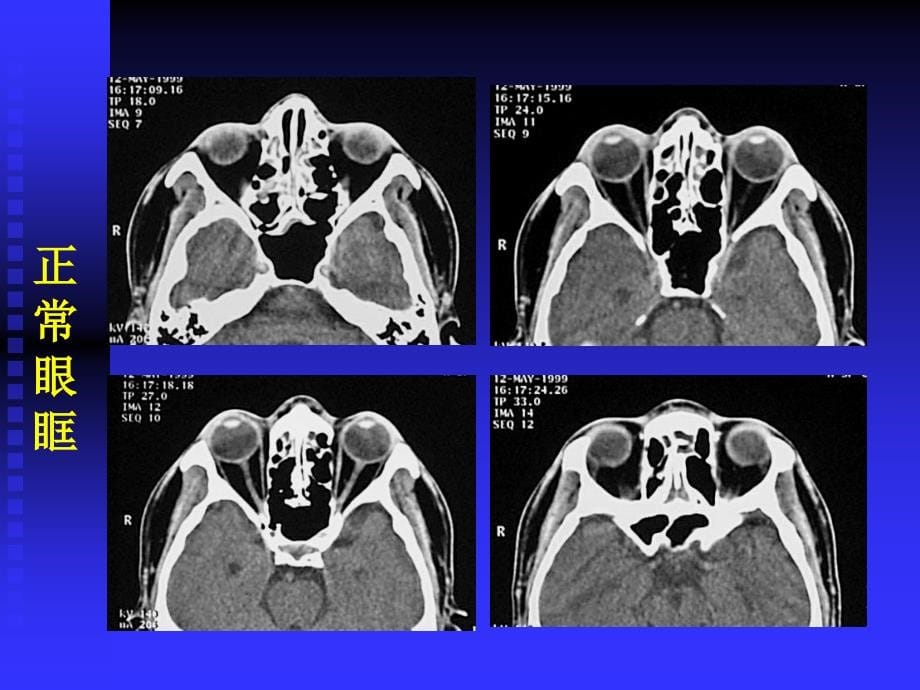 眼与眼眶CT检查_第5页
