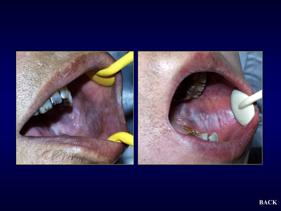口腔粘膜斑纹类疾病_第4页