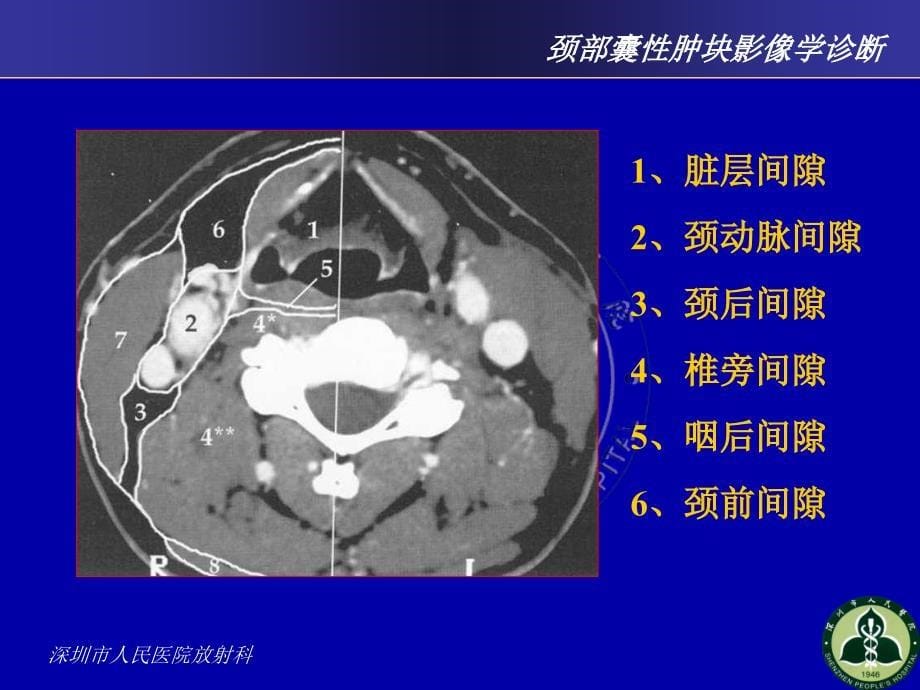 颈部囊性肿块影像学诊断_第5页