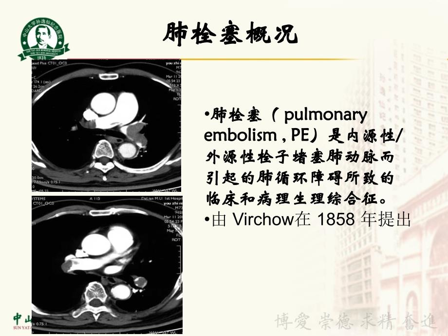 刘尚礼椎间孔镜技术_第2页