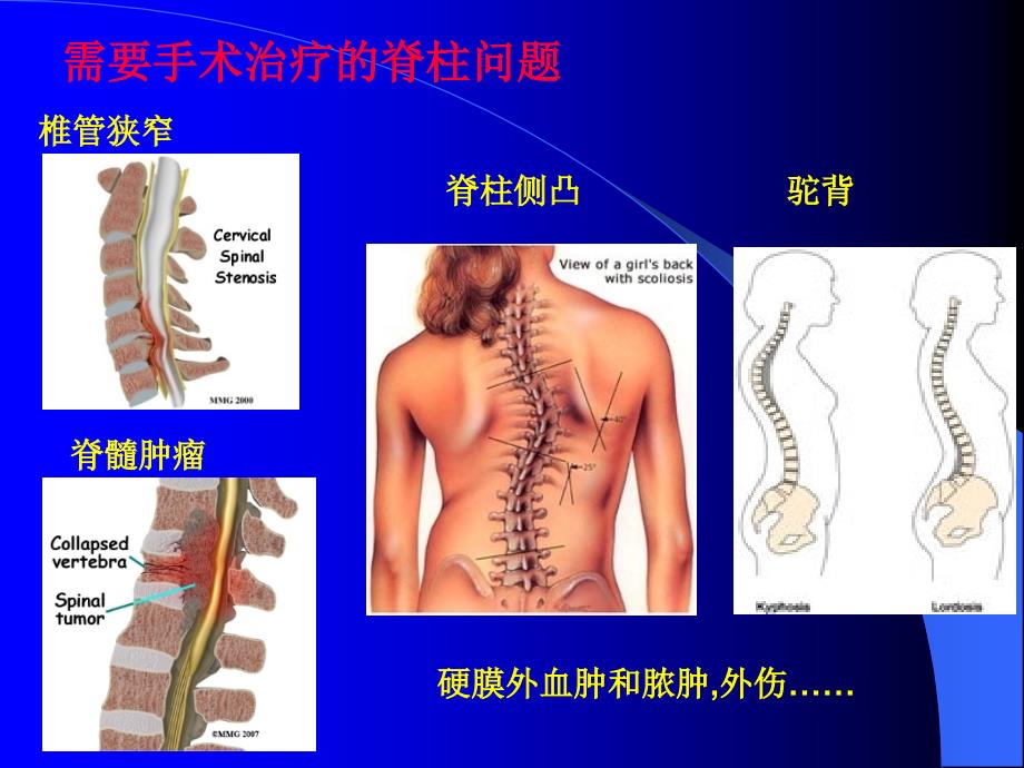 脊柱手术的麻醉_第3页