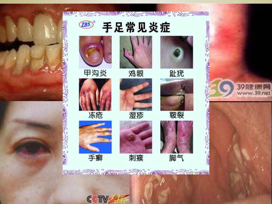 炎症(以急性化脓性扁桃体炎为例)【大体】_第2页