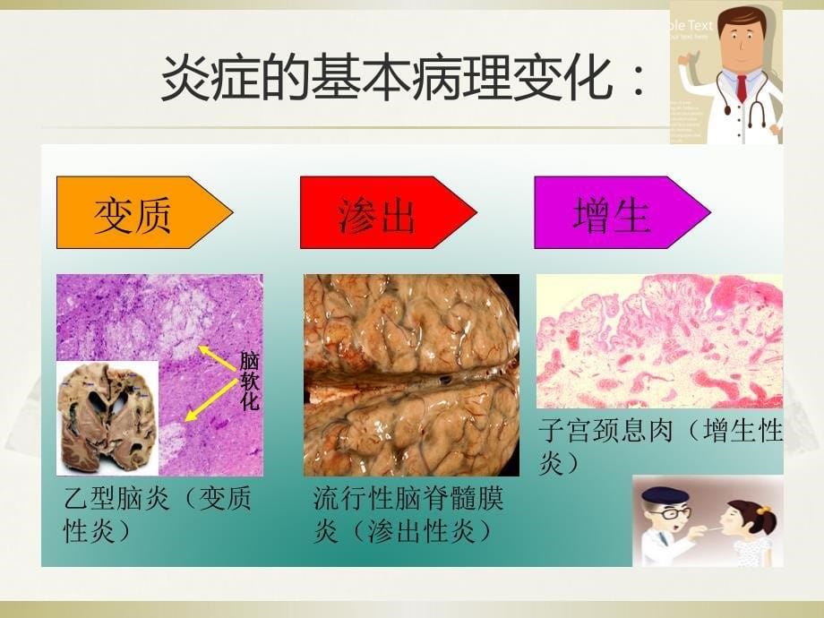 炎症(以急性化脓性扁桃体炎为例)【大体】_第5页