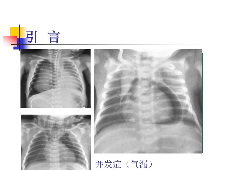 新生儿机械通气_第3页