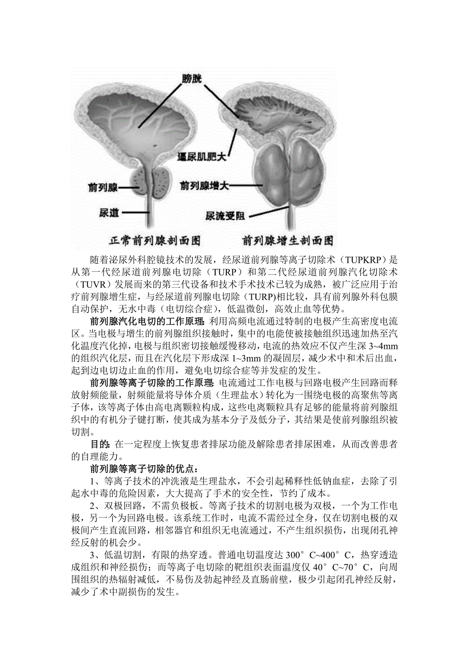 前列腺等离子切除_第2页