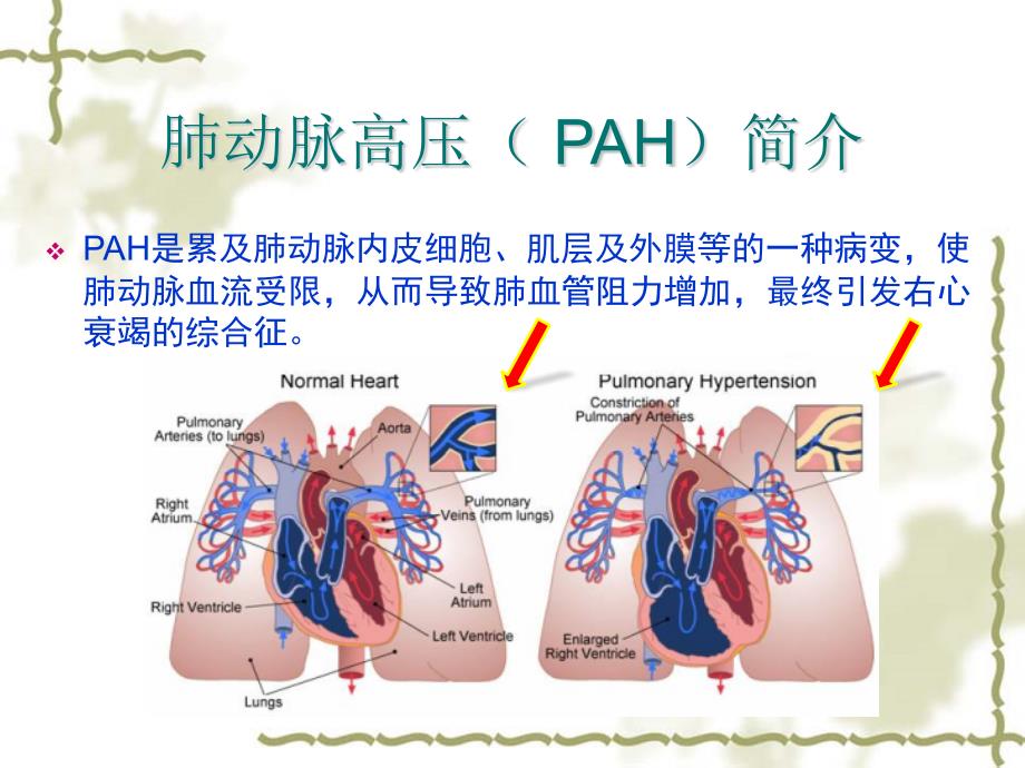 肺动脉高压指南_第2页