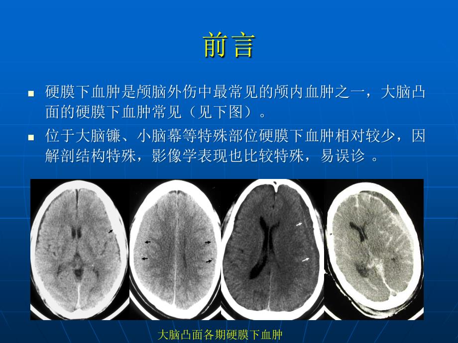 小脑幕硬膜下血肿_第3页