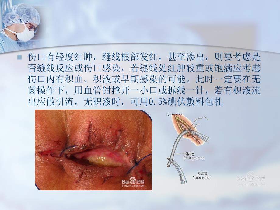 各类伤口的处理要点及注意事项_第4页